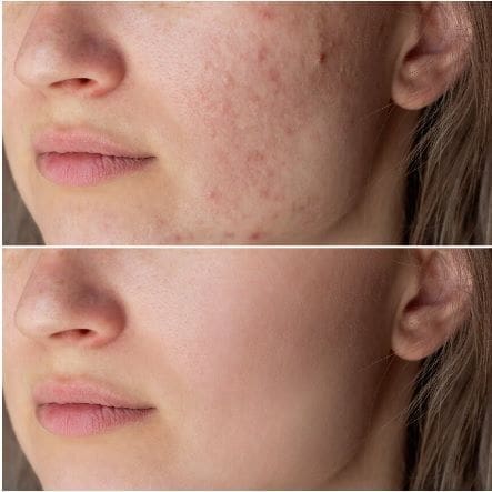 Best Acne Scar Treatment In Hyderabad