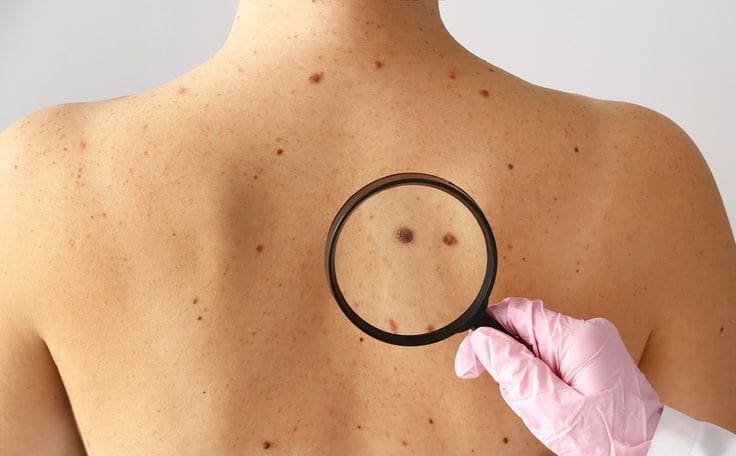 When To Get Checked For Skin Cancer Risk Factors And Key Signs