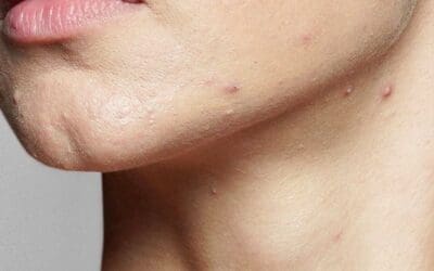 Skin Programs & Targeted Skin Solutions l Custom Skin Programs: How The Skin Nurse Tailors Packages to Your Concern from Pigmentation to Acne to Aging