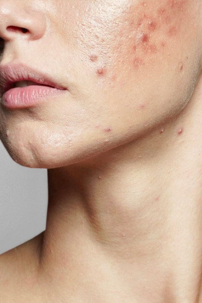 Dermatologists Share the Best Acne Advancements of the Last Years