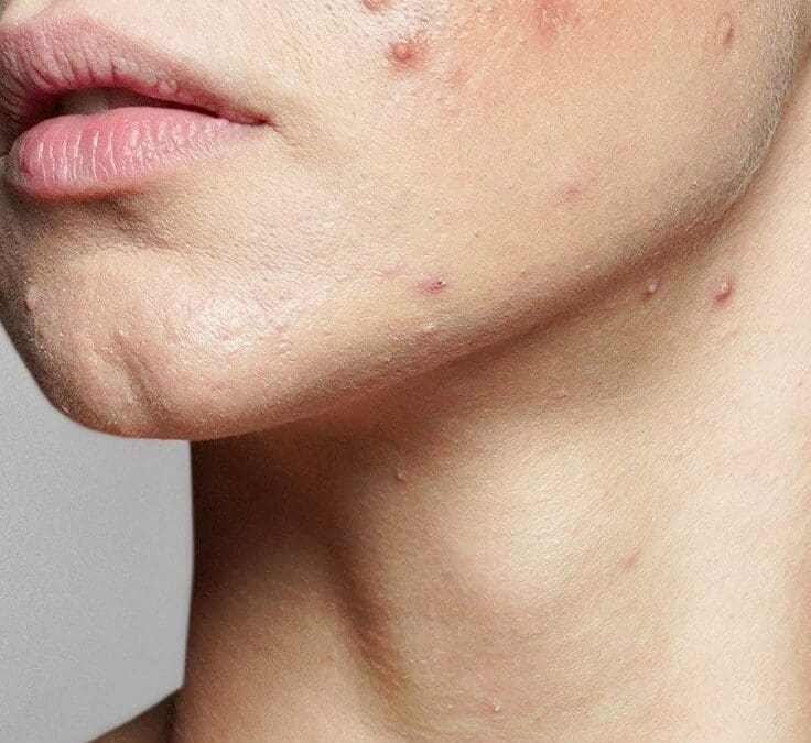 Skin Programs & Targeted Skin Solutions l Custom Skin Programs: How The Skin Nurse Tailors Packages to Your Concern from Pigmentation to Acne to Aging