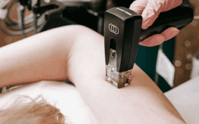 RF Skin Tightening in Perth: A Non-Surgical Solution for Firmer Skin