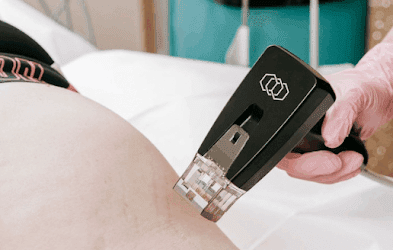 10 Reasons Why Morpheus 8 RF Perth is the Best RF Microneedling Technology