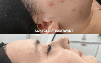 Why Enzyme Facial Perth Is Becoming the Go-To Treatment for Skin Health