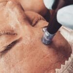 Microneedling Aftercare All You Need to Know