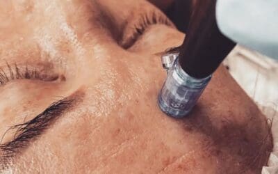 Microneedling with Insulin: A New Standard in Skin Regeneration