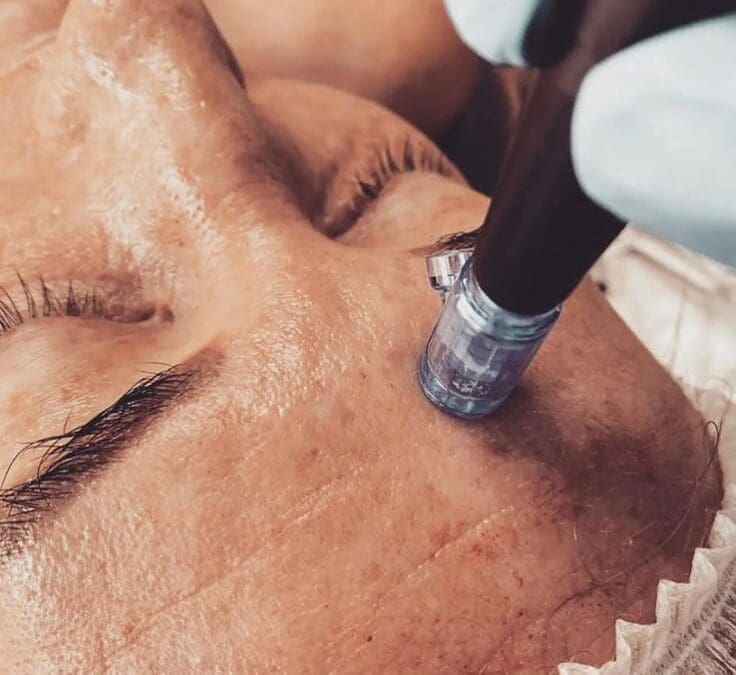 Microneedling Aftercare All You Need to Know