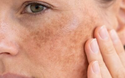 Melasma, Sunspots & Hyperpigmentation: What’s the Difference?